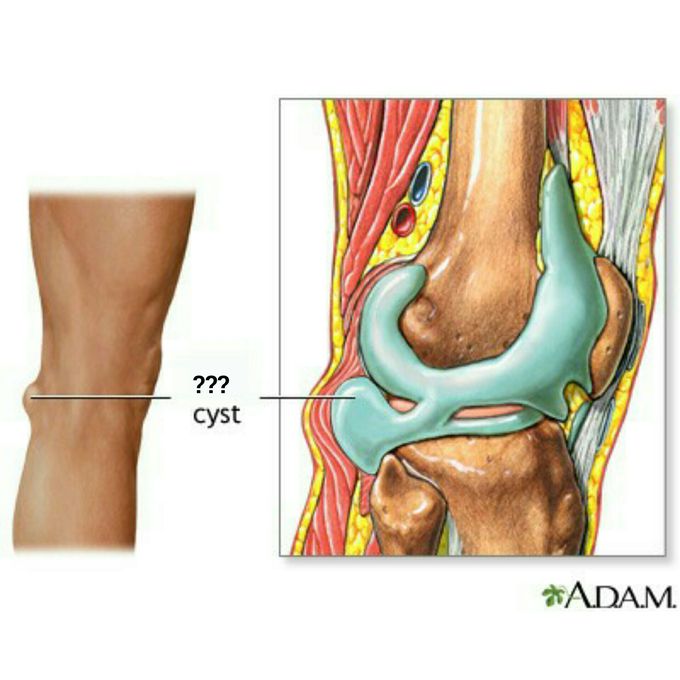 What's the name of this cyst ?!!