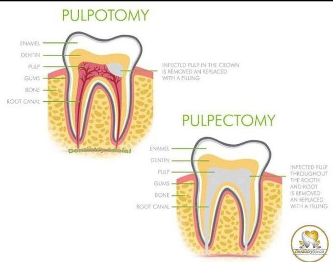 Pulpotomy And Pulpectomy