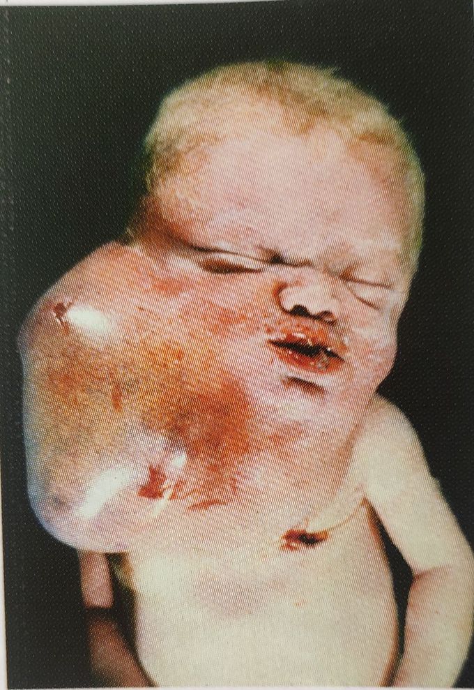 Cystic hygrroma of neck