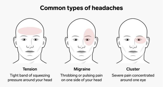 Types of Headache - MEDizzy