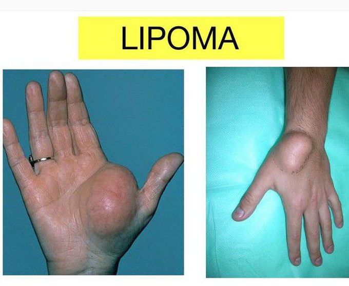 Lipoma