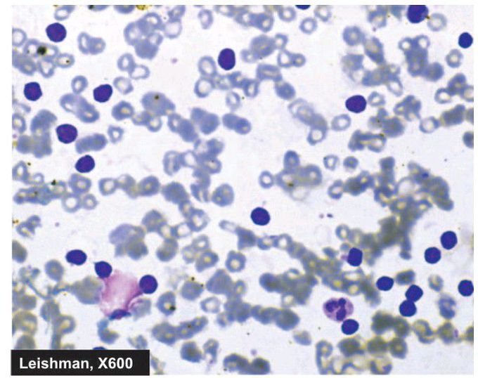 Lymphocytosis