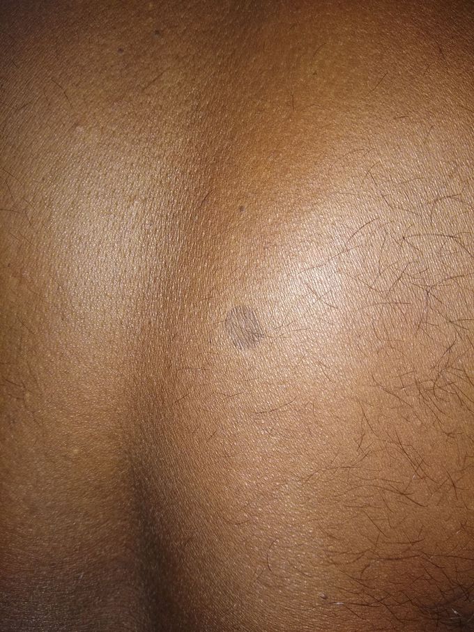 Diagnose the skin disorder
