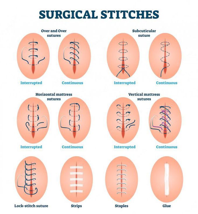 surgical sutures