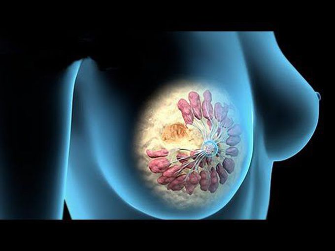 Treatments of Breast Cancer