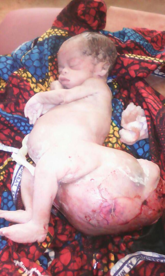 The Newborn baby with Congenital desease