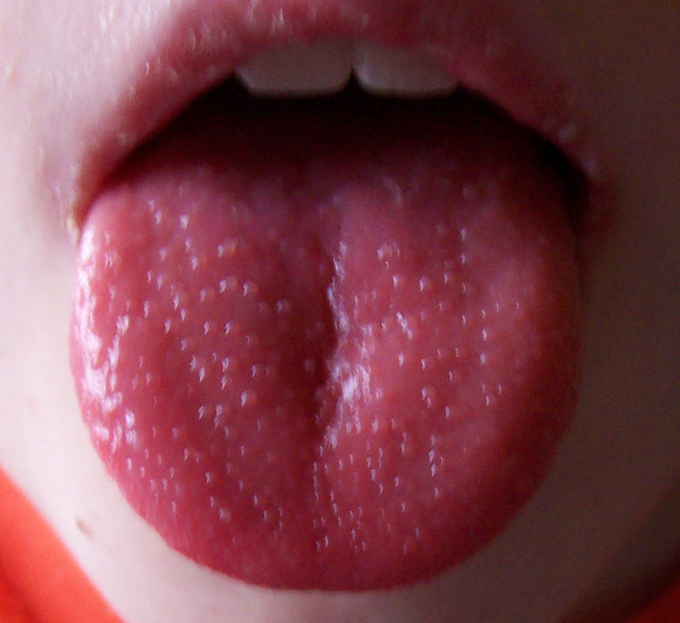 Strawberry tongue seen in scarlet fever and Kawasaki disease