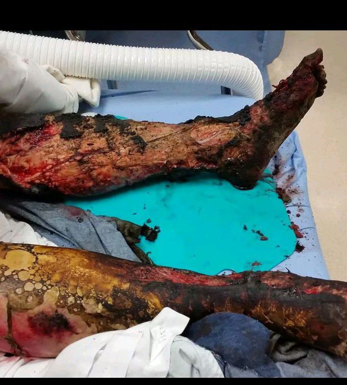 Burn injury