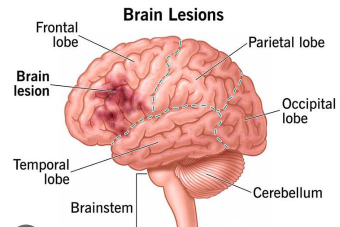 Brain lesion