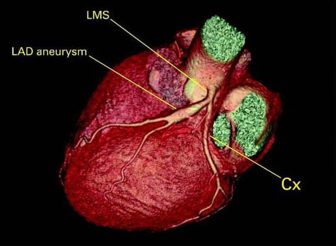 Kawasaki disease(mucocutaneous lymph node syndrome)