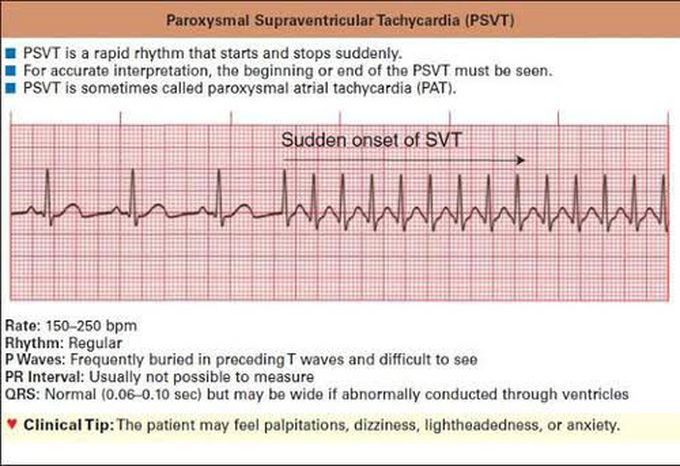 Paroxysmal Supraventricular Tachycardia