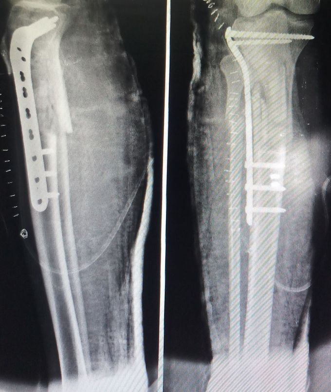 Left Leg