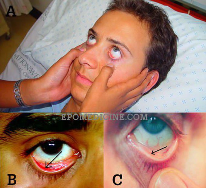 Pallor examination