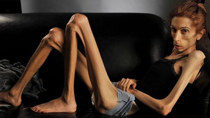 Anorexia nervosa