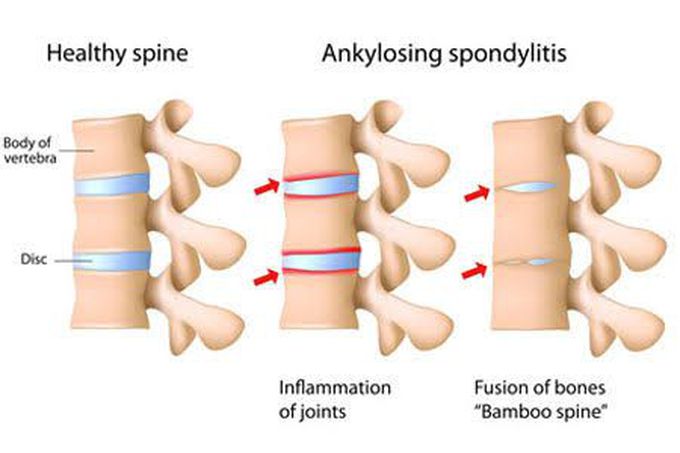 Ankylosing Spondylitis