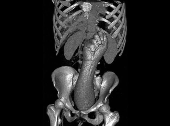 The craziest case I’ve ever seen: this patient likely presented with abdominal pain,and/or admitted that they had large fist sex toy stuck in their rectum 😳                                                                          Source: Themedicalmentors