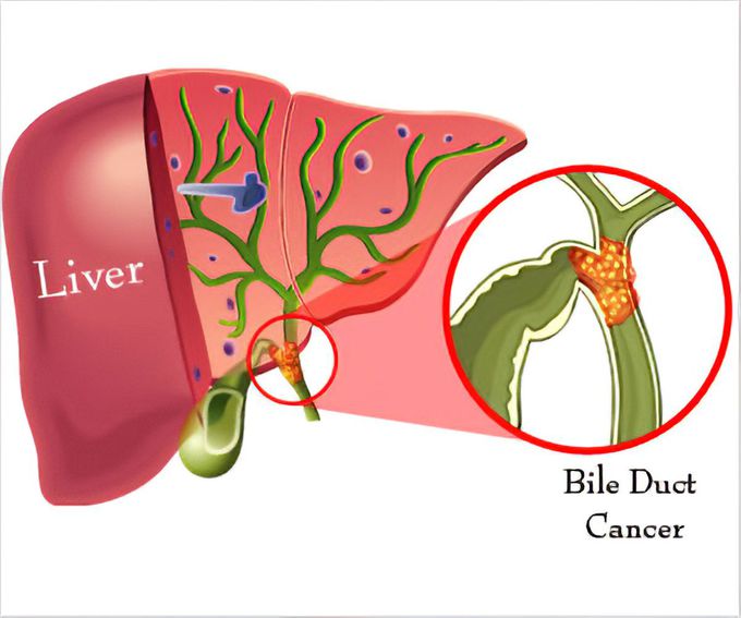 Bile duct cancer (cholangiocarcinoma)