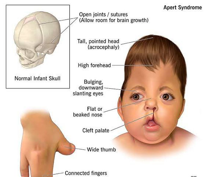 These are the features of Apert syndrome