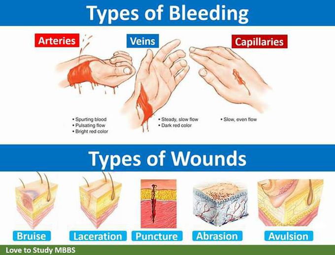 Types of wound
