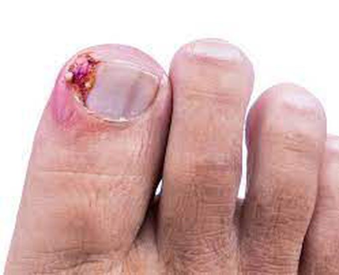 Ingrown toe nail