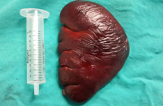 Spleen removed by laparoscopic technique