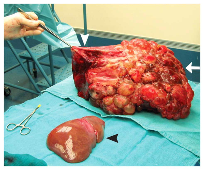 Liver