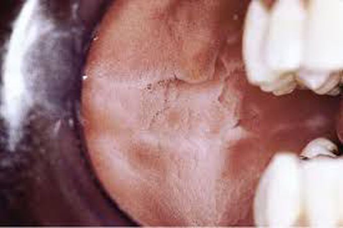Leukoedema