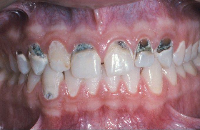 Methamphetamine-related Dental Caries