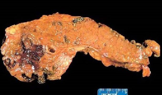 Acute Pancreatitis
