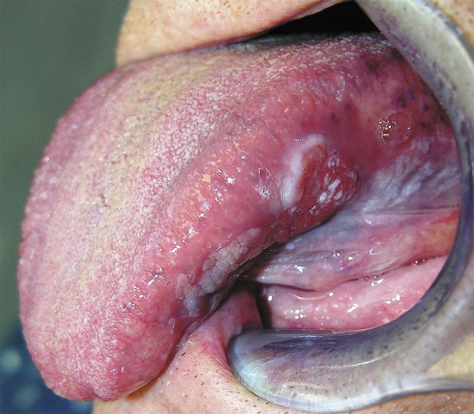 Lingual Squamous-Cell Carcinoma