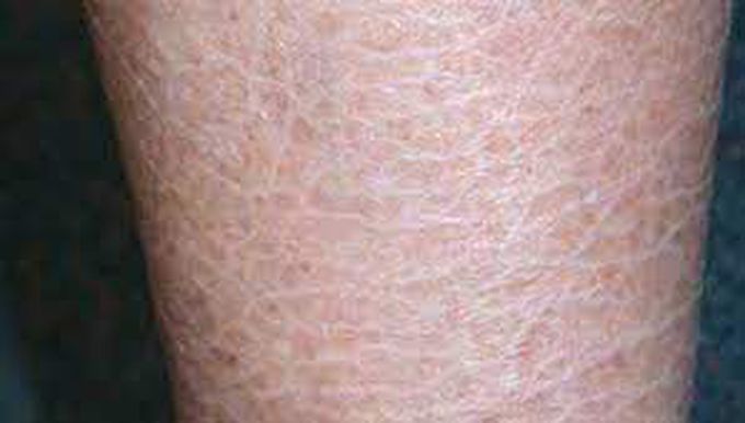 What are the symptoms of ichthyosis vulgaris?