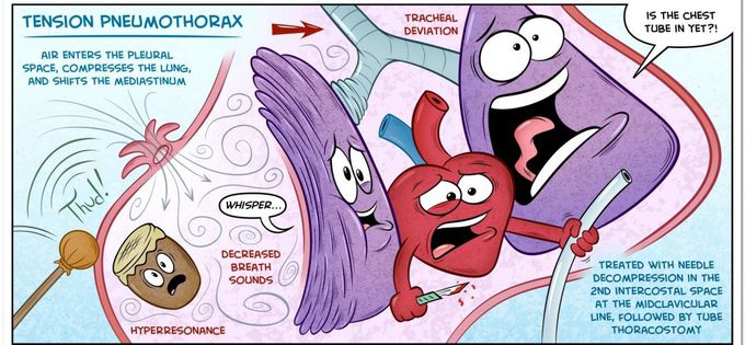 TENSION PNEUMOTHORAX