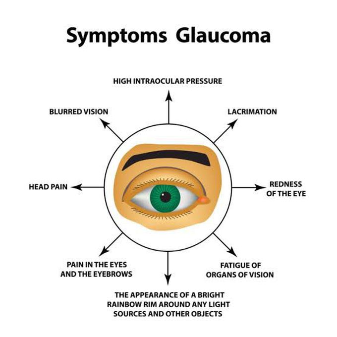 Following are the symptoms of glaucoma.
