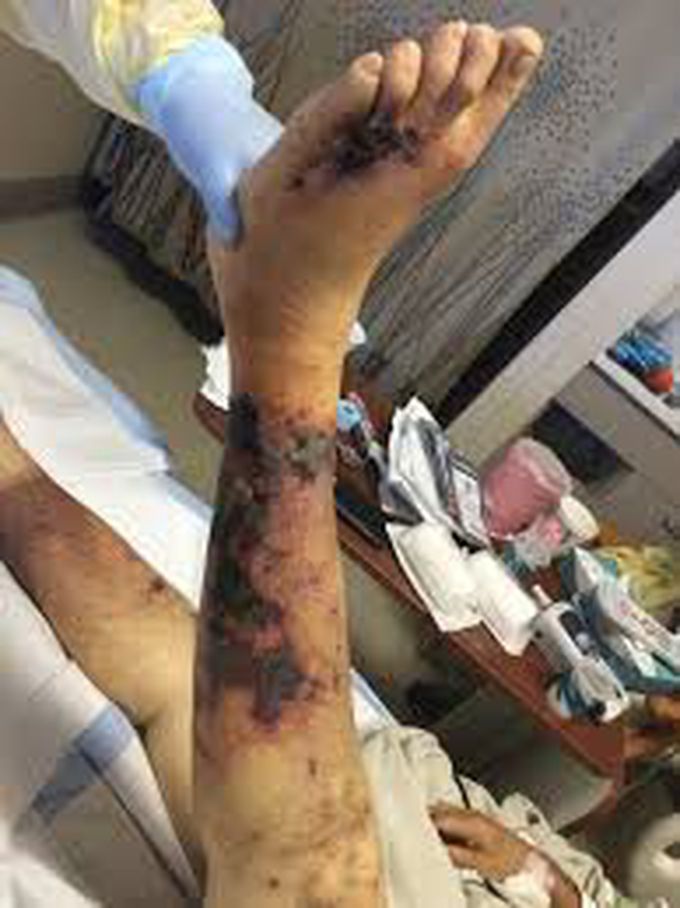 Calciphylaxis