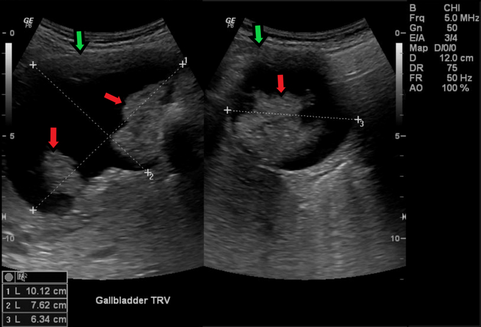 Gallbladder Cancer