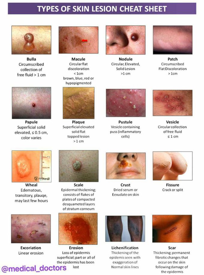 Type of Skin Lesion