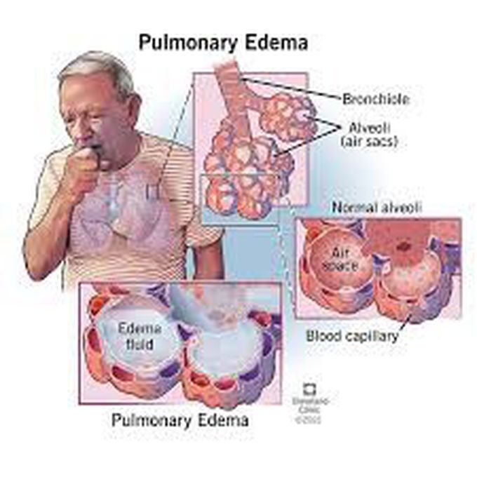 Cause of pulmonary edema