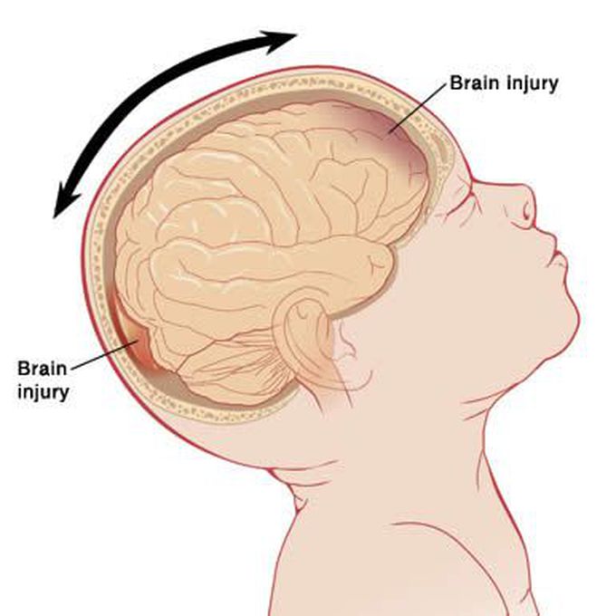 Shaken Baby Syndrome (SBS)