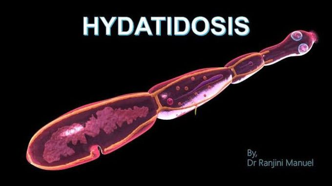 Hydatidosis