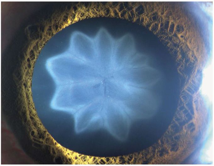 Petaloid Cataract