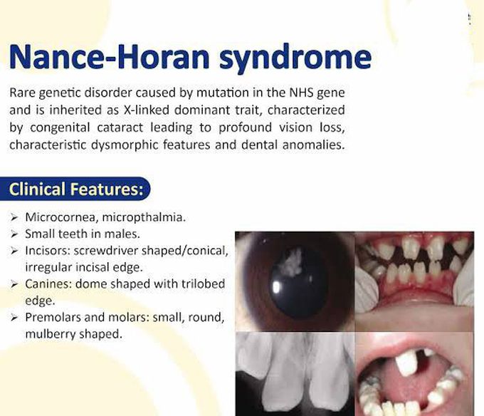 These are the clinical features of Nance horan syndrome