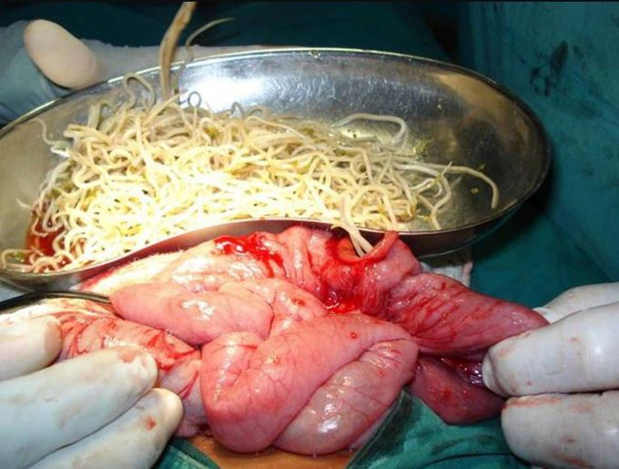 Extraction of Ascaris lumbricoides from jejunum. 