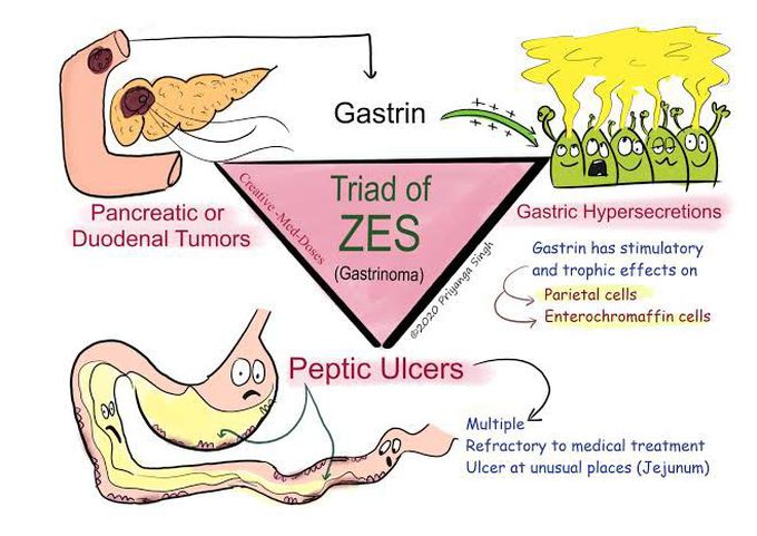 Zollinger Ellison Syndrome Triad