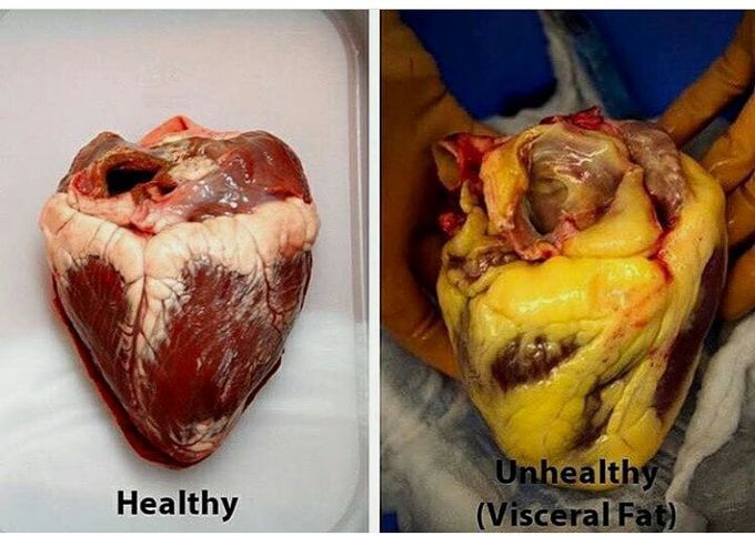 Visceral fat on heart!