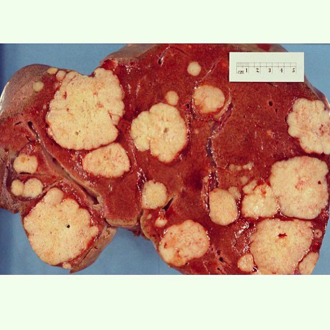 Liver metastasis