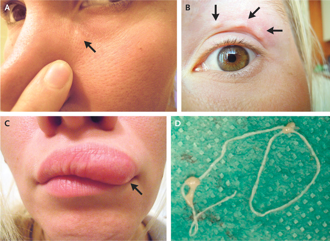 Lump On Woman's Face Turns Out To Be A Parasite Crawling Under Her Skin