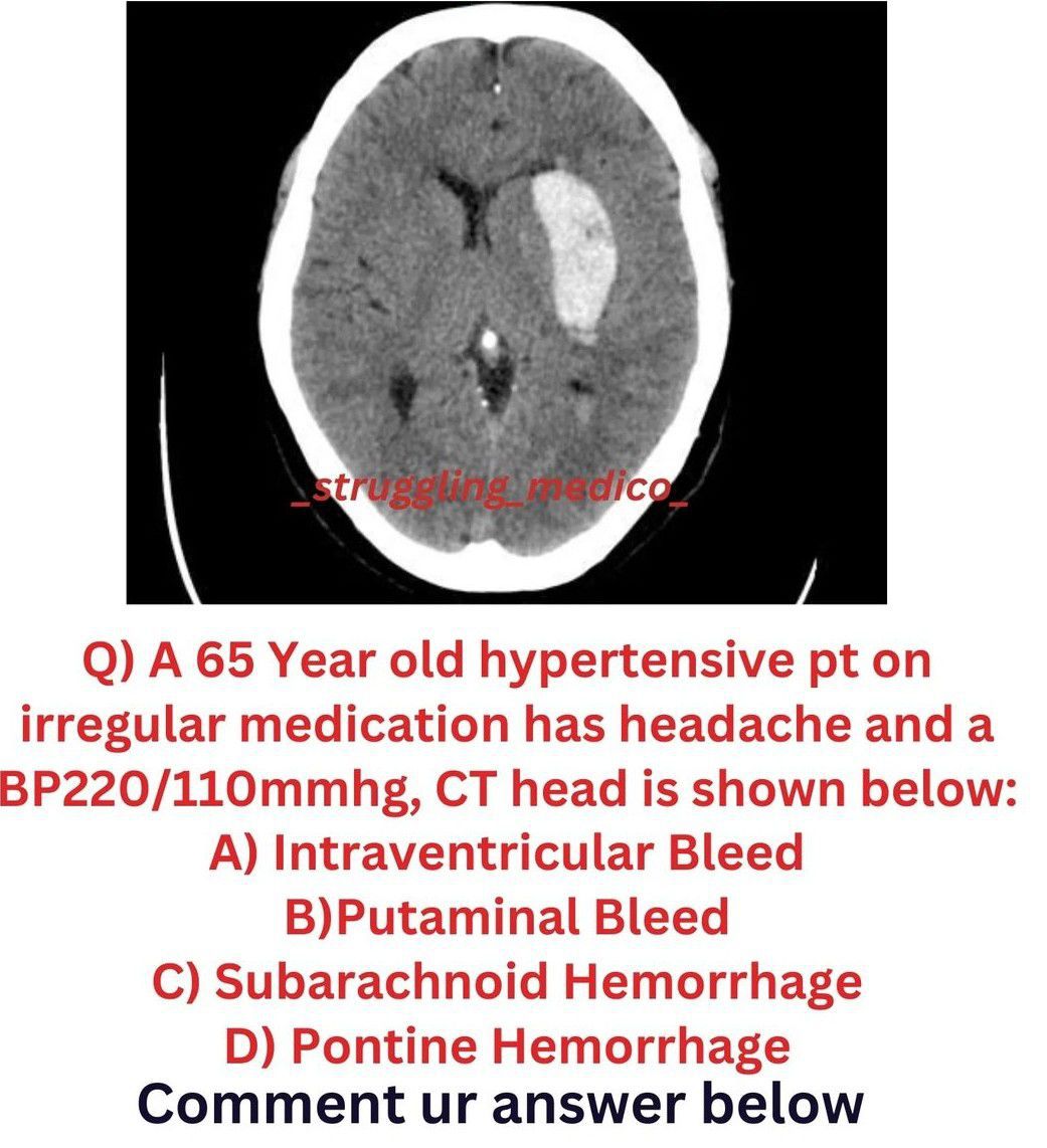 Identify the Brain Bleed - MEDizzy