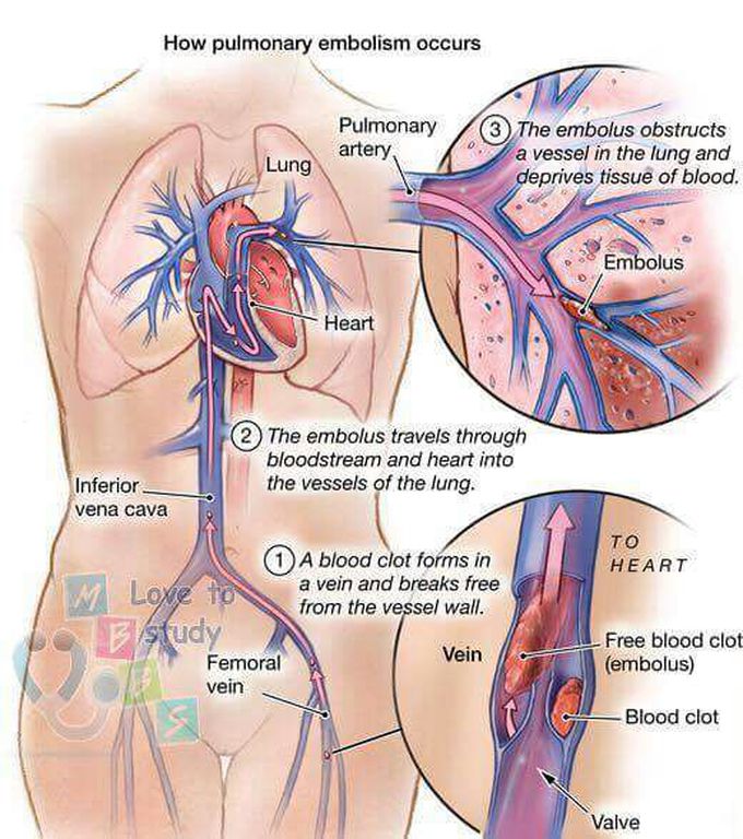 Pulmonary embolism process