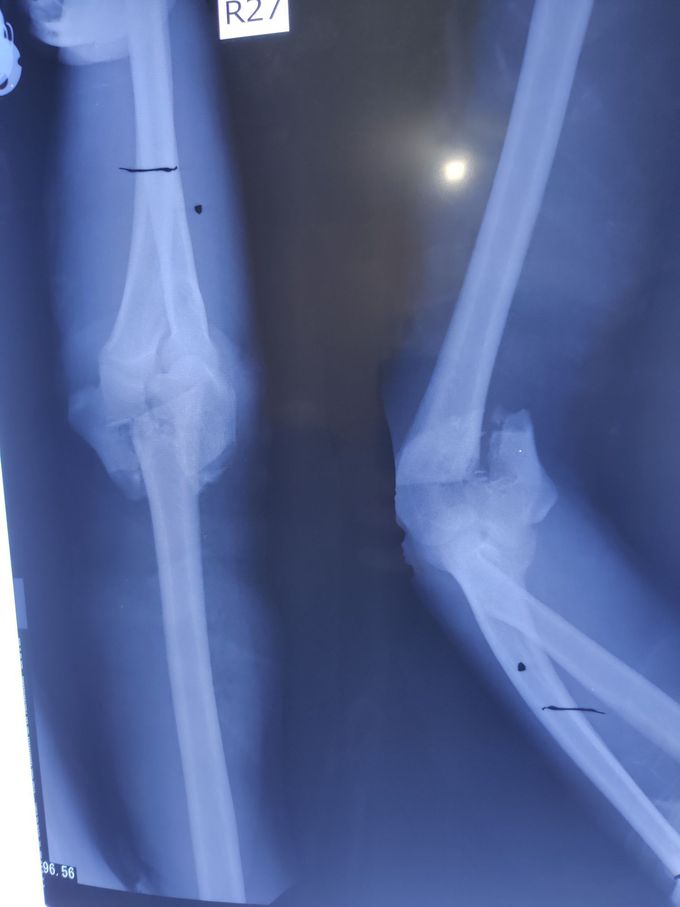 Elbow Fracture