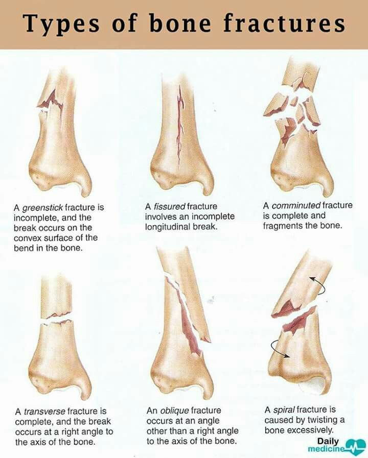 Types of Fractures - MEDizzy